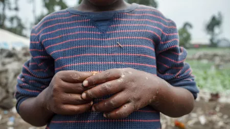 Hands of a child infected by mpox disease. 