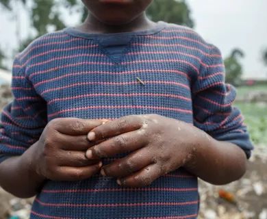 Hands of a child infected by mpox disease. 